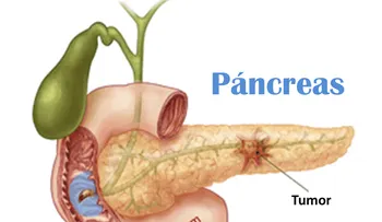  5 señales que si las ignora te puede desarollar un cáncer de páncreas