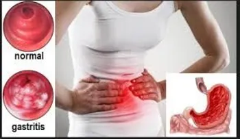 Este remedio elimina para SIEMPRE la gastritis y la acidez