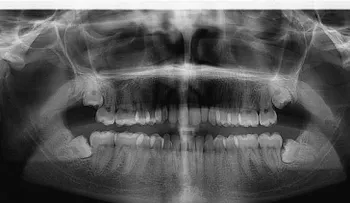La periodontitis podría ser un signo precoz de una diabetes no diagnosticada