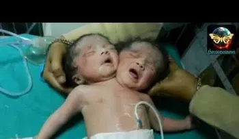 Video: Nacen Siameses con un sólo cuerpo y dos cabezas en la India 