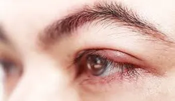 Entérate por qué se te hinchan los ojos