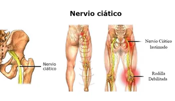 Desbloquear el dolor del nervio ciático en 2 minutos y parar el dolor