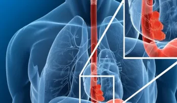 Cáncer de esófago es curable si se diagnostica a tiempo