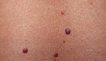 Los puntos rojos en la piel