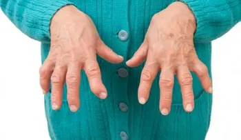 6 cosas que debes saber de la artritis reumatoide