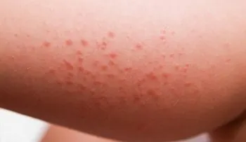 Remedio para plurito cutáneo: Cataplasma de Pepino, agua de azahar y aloe vera
