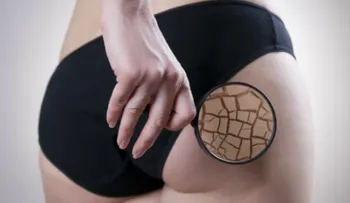 La mayor causa de la celulitis no es la grasa, dice nutricionista