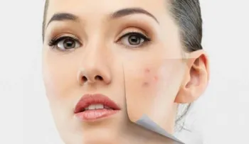 Seis remedios para quitar las manchas en la piel
