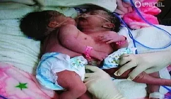Nacen siamesas unidas por el corazón en Bolivia