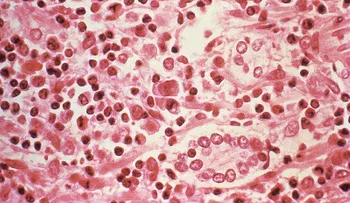  En este país un virus mortal ha aumentado su incidencia en un 81 por ciento