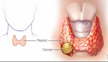 La mayoría de los casos de cáncer de tiroides son curables