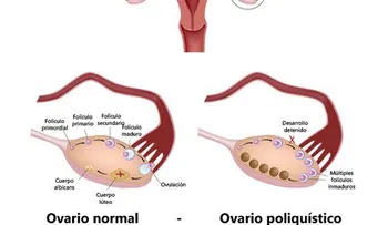 Encuentran posible cura al síndrome de ovario poliquístico