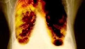 El cáncer hepático y de pulmón siguen siendo letales en todas las naciones. ¿En qué países se sobrevive más 