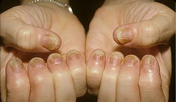 Tratamientos para la psoriasis en las uñas