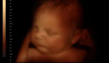 Bebé nace embarazada de gemelos en Hong Kong
