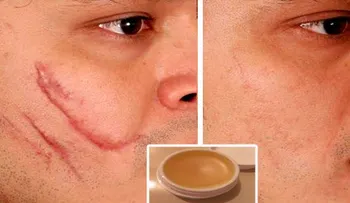Para eliminar cicatrices de cualquier parte del cuerpo en 2 semanas prueba esta crema casera!
