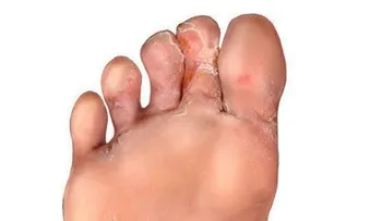 El uso de zapato cerrado puede causar el pie de atleta 