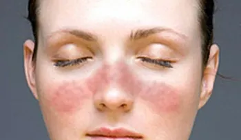 El mundo celebra esta noticia: Universidad de Florida descubre cura para Lupus