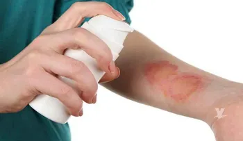  Desarrollan hidrogel para cicatrizar heridas y retorna la piel humana a su normalidad