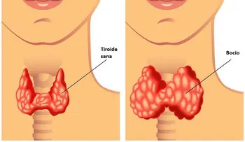 Estos remedios te curan las tiroides para siempre: los médicos nunca de lo dirán