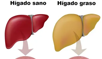 Síntomas, causas y tratamientos para la grasa en el hígado
