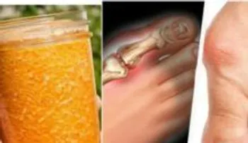 Un especialista de salud le recomendó este jugo para aliviar las inflaciones y la gota y dejó de usar medicamentos 