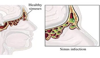 Cómo aliviar tu infección sinusal en 20 segundos
