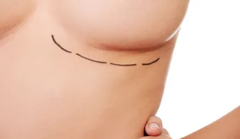 Implantes mamarios: cinco dudas para despejar antes de OPERARTE
