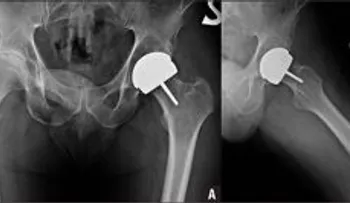 Denuncian práctica de cambiar implantes