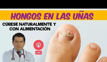 Tratamiento natural para los hongos en las uñas, revelado por el doctor Javier Moreno