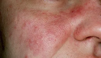 5 pasos para recuperarse del lupus