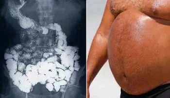 Con esto mi abuelo eliminó para siempre la hinchazón en su panza. Informate
