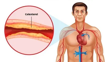 Cómo destapar las arterias del corazón con remedios naturales
