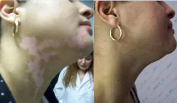 El mundo celebra; cientificos cubanos descubren la cura del vitiligo