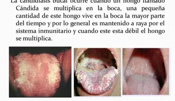 ¿Cómo se cura la candidiasis?