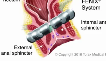 Mayo Clinic es la primera en implantar dispositivo para la incontinencia fecal