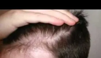 Un tratamiento para prevenir la caída del pelo (VIDEO)