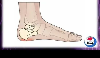 Cómo curar el dolor de talon (espolón) (VIDEO)