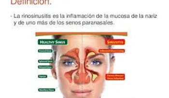 Rinosinusitis crónica puede afectar el sueño, el ejercicio y la actividad física