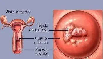 Brasil comienza a vacunar a los niños contra el virus del papiloma humano