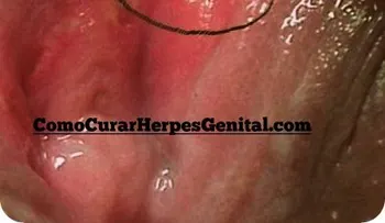 Cómo curar la candidiasis genital masculina
