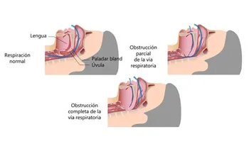 Tratamientos naturales para los ronquidos