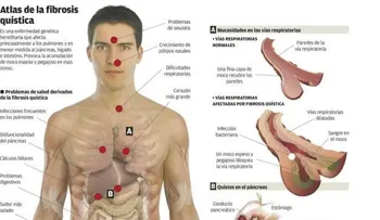 Fibrosis Quística; causas y tratamiento (VIDEO)