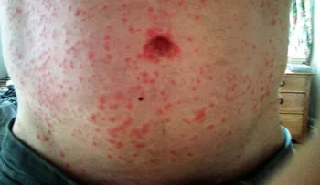 Virus El Mayaro detectado en Haití, tiene preocupado a dominicanos; SP vigila 