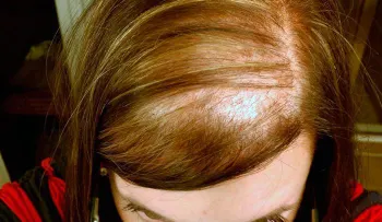 La alopecia (caída del cabello) y su aparición luego del embarazo