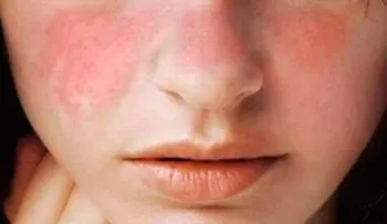 Lupus, la enfermedad autoinmune que azota al cuerpo