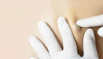 Quistes en las axilas causas y cuando acudir al médico
