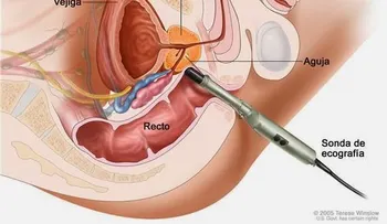  Un test de sangre que evita el 50% biopsias de próstata, Premio Innoveit 2017 