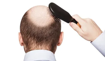  Estudiantes crean tratamiento para combatir alopecia a base de nuez 