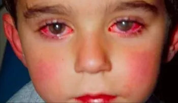Quemadura en los ojos: Un niño perdio la vista a causa de este juguete que probablemente tengas en tu casa